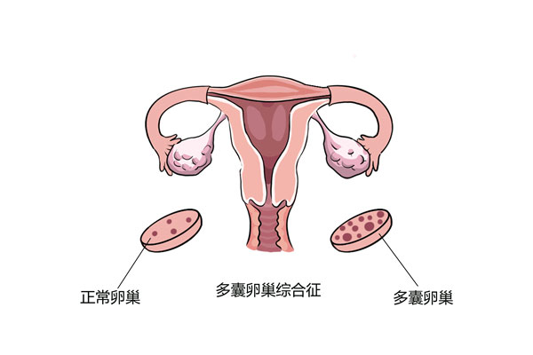 多囊，超越妇科领域的迷雾与挑战——不仅仅是一种妇科病