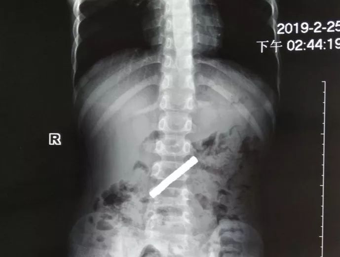 震惊！体内惊现长达2.73米绦虫，生命岌岌可危！揭秘真相与防治方法。